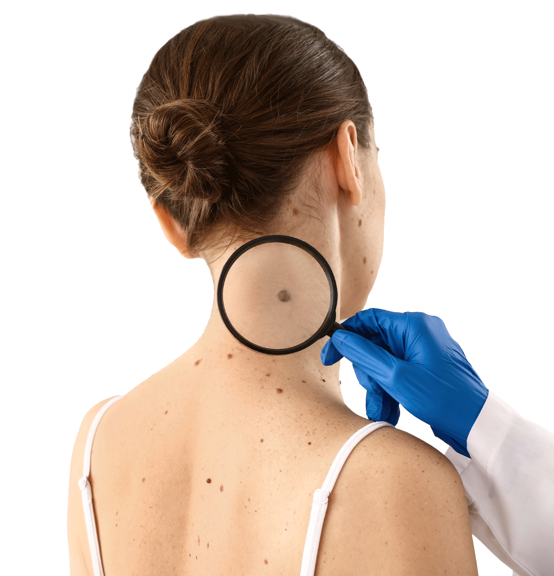 7 steps for mole removal Sacramento California