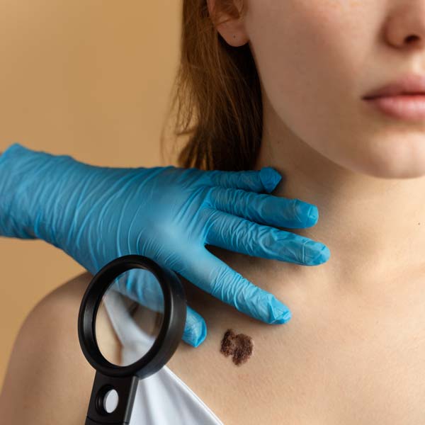 expert mole removal Sacramento California