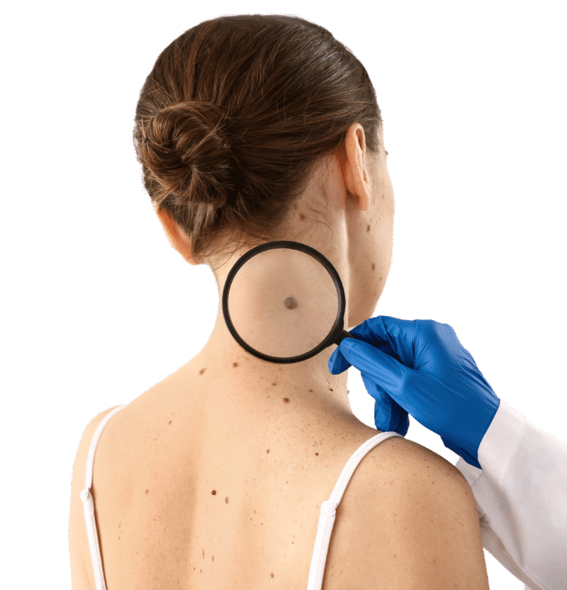 7 steps for mole removal san bernardino