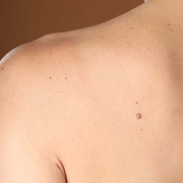 affordable mole removal Redlands