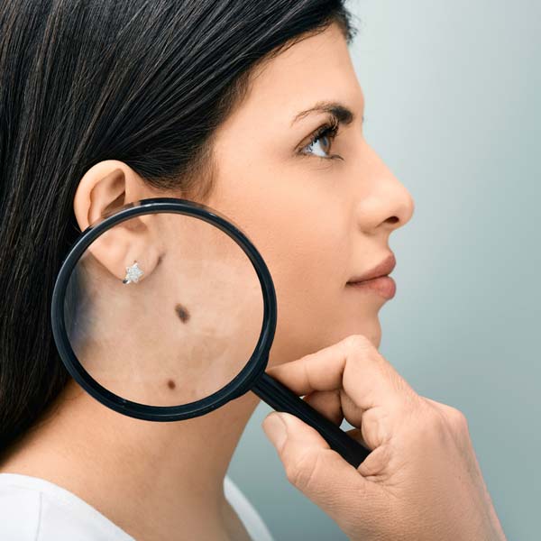 affordable mole removal san bernardino