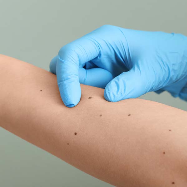 expert mole removal Rancho Cucamonga