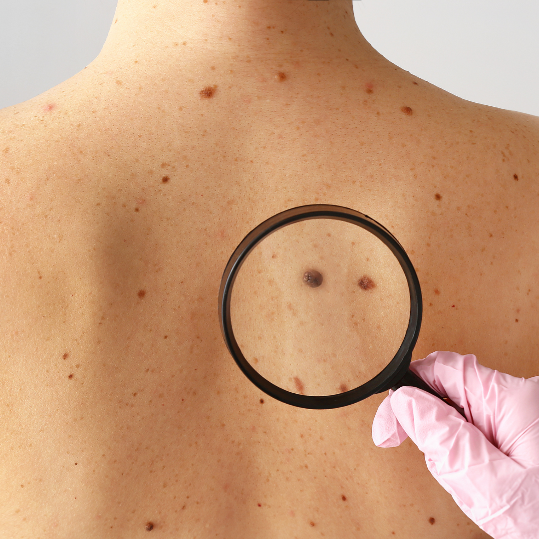 how much does mole removal cost