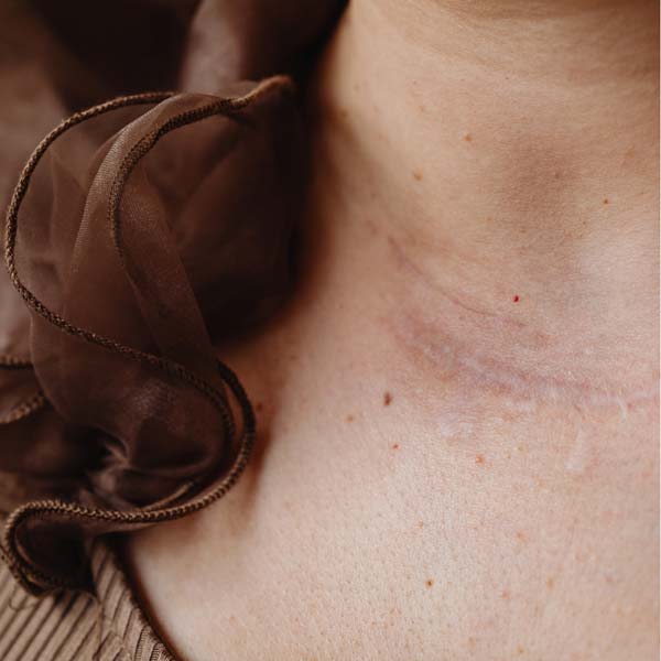 professional mole removal redlands california