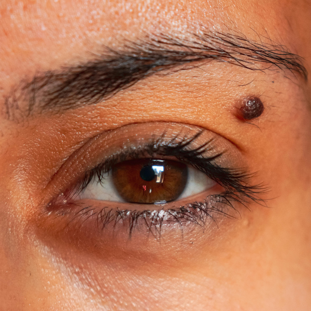 mole removal is safe on darker skin tones