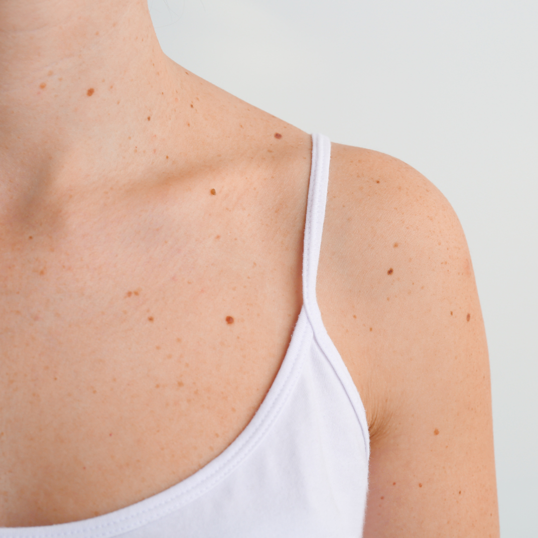 Laser Mole Removal vs Radiofrequency Ablation