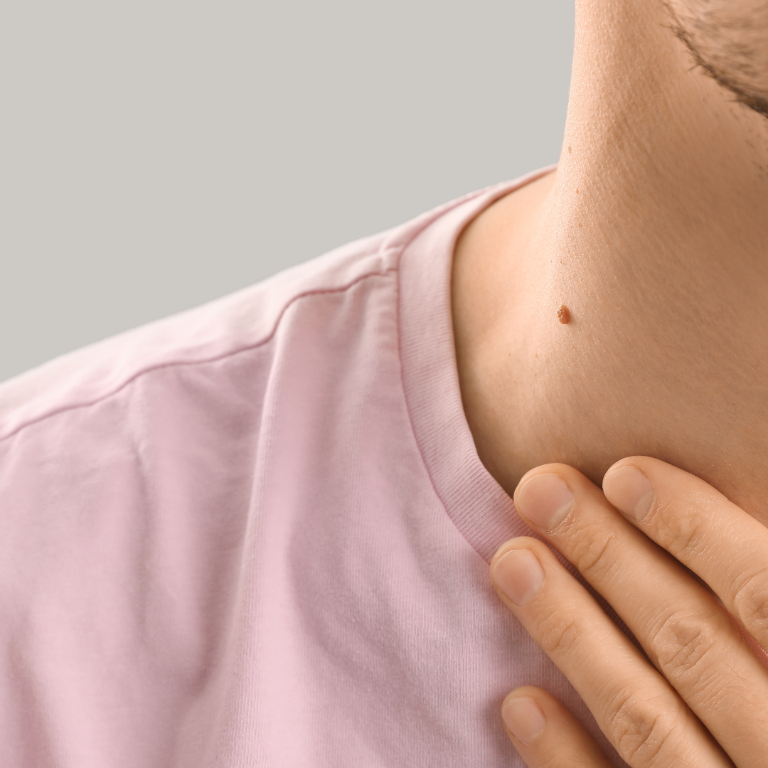 affordable mole removal Ontario California