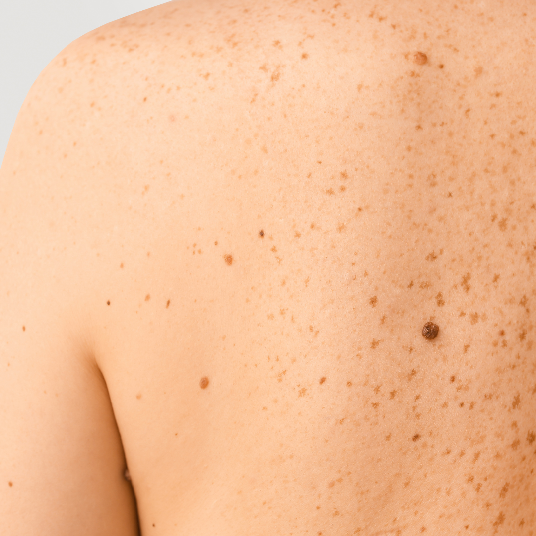 best mole removal Fontana california