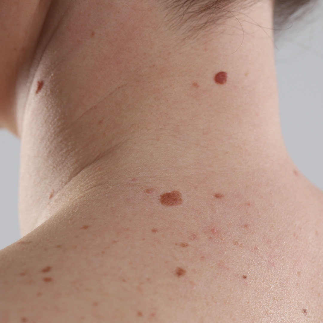 professional neck mole removal