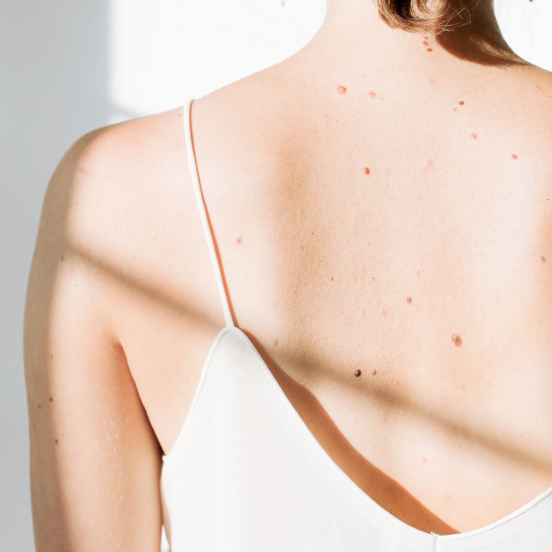 scarless Mole Removal Yucaipa