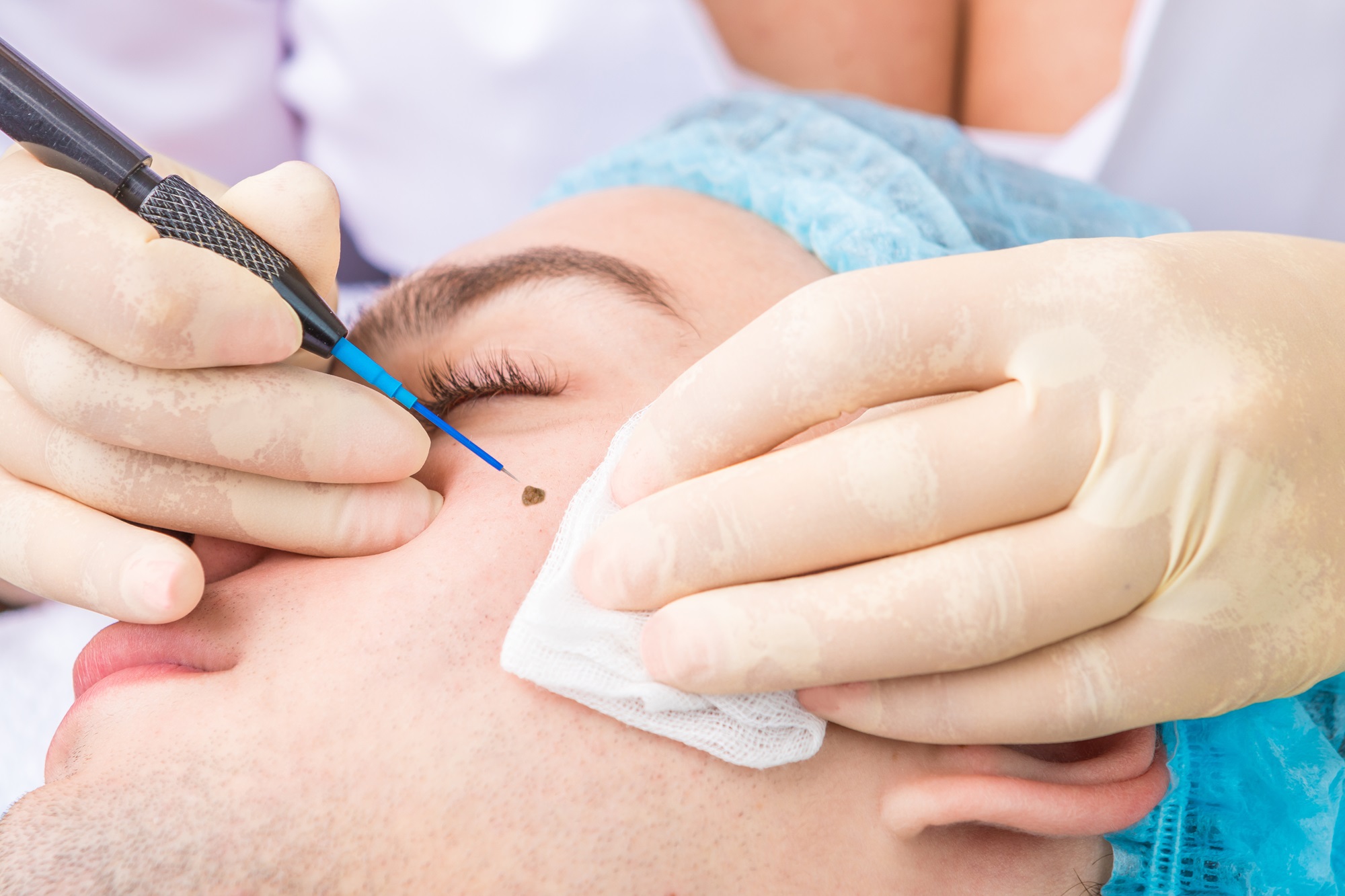 top rated mole removal ontario california