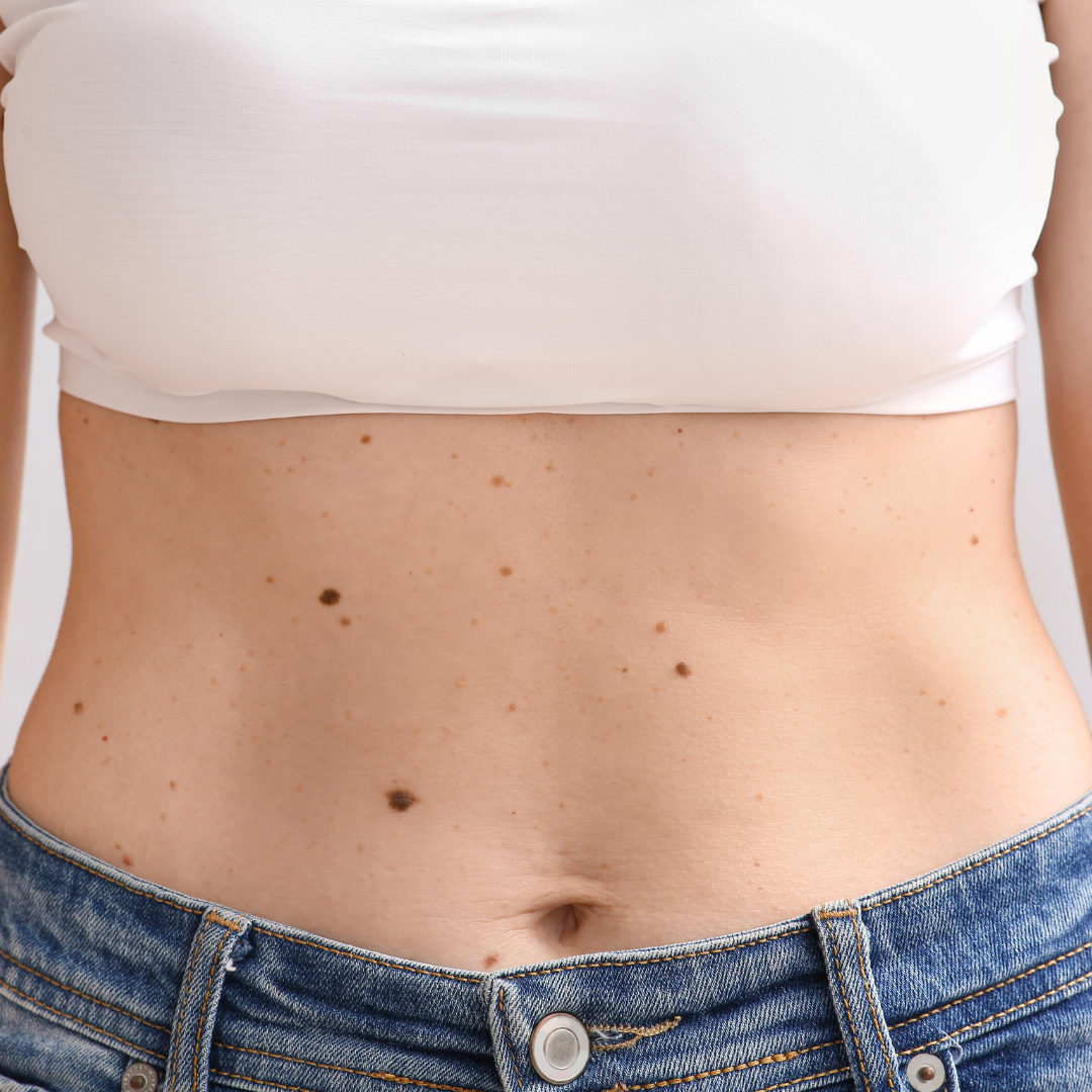 affordable mole removal loma linda california