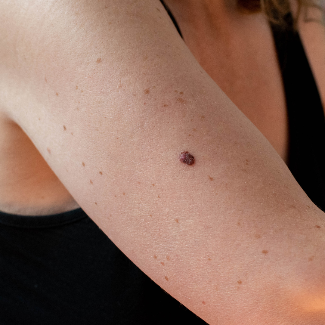 affordable mole removal Rialto California