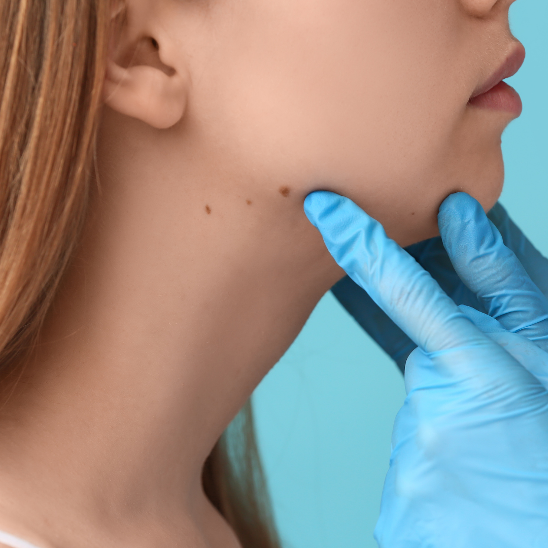 avoid at-home mole removal